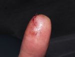 finger_24hr_post.JPG finger_24hr_post.JPG